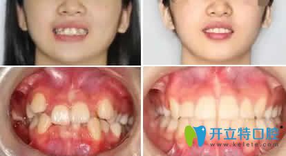 湛江致美口腔梁陳生牙齒擁擠矯正案例效果圖