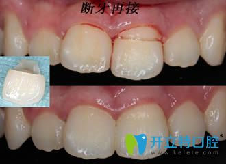 開(kāi)立特口腔：牙斷了能接嗎