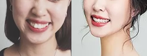 讓大家見證下我在重慶齊美口腔矯正齙牙、兔子牙511天變化