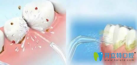 開立特口腔解答噴砂潔牙和超聲波潔牙的區(qū)別在哪