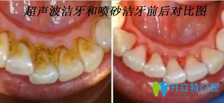 開立特口腔解答潔牙后注意事項(xiàng)