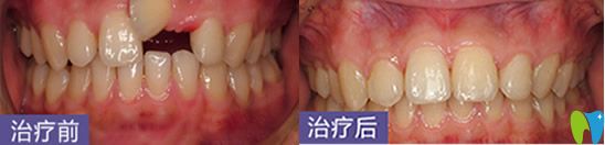 深圳烤瓷牙哪家好？鵬程口腔牙齒修復(fù)案例來嘍