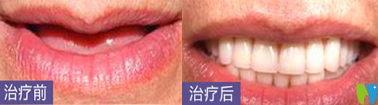 深圳哪家種植牙好？看深圳鵬程口腔種植牙案例
