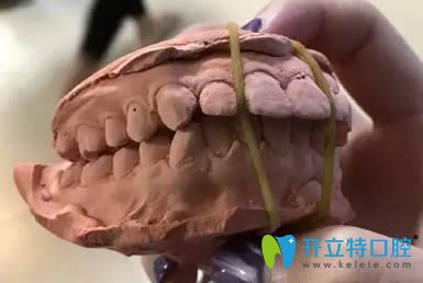 圍觀我花5萬(wàn)多讓廈門(mén)賽德陽(yáng)光洪慈憶做的齙牙矯正怎么樣？