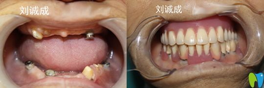 劉誠成種植+套筒冠修復(fù)案例