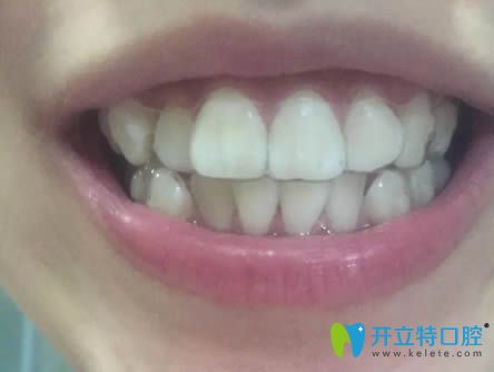戴隱形牙套一周后的照片