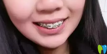 在拉斐爾口腔做牙齒矯正第6個月