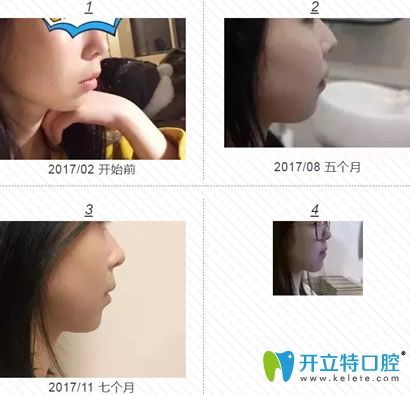 去福州格萊美口腔做1-11個(gè)月右臉變化圖片