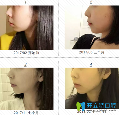 我在福州格萊美做牙齒矯正1-11個(gè)月左臉變化過程圖