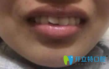 我在濰坊可恩口腔做隱形牙齒矯正第3個(gè)月照片
