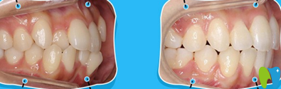 福州格萊美口腔吳和峰牙齒隱形矯正案例