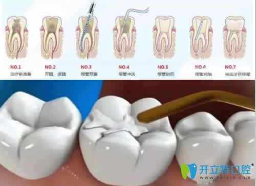 武漢優(yōu)益佳口腔潘斌醫(yī)生介紹根管治療步驟 武漢優(yōu)益佳口腔潘斌醫(yī)生介紹根管治療步驟