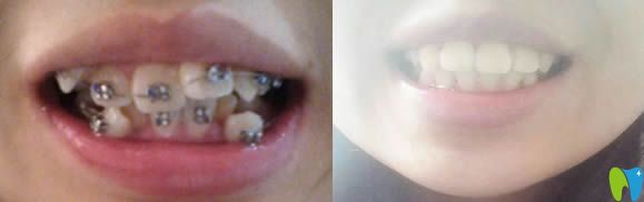 在泉興口腔拔了4顆牙矯正后的牙齒對(duì)比圖