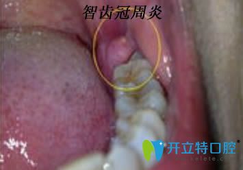 急性智齒冠周炎圖