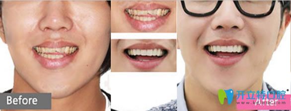 雷桂芳醫(yī)生前門牙修復前后對比案例 雷桂芳醫(yī)生前門牙修復前后對比案例