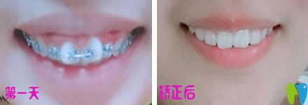 牙齒只有一兩顆不齊可以做半口矯正嗎？來看北京中諾口腔半口牙矯正真人案例