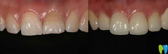 威海舒好口腔于英霞牙齒美容修復(fù)效果對比圖 威海舒好口腔于英霞牙齒美容修復(fù)效果對比圖