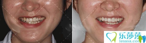<!--<i data=20240703-sp></i>-->岳秀清醫(yī)生口腔修復案例對比圖 <!--<i data=20240703-sp></i>-->岳秀清醫(yī)生口腔修復案例對比圖