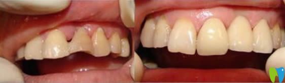 威海舒好口腔李歡牙體修復(fù)效果對比圖：