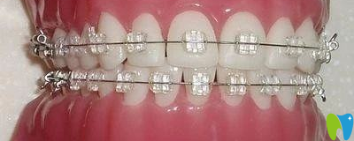 傳統(tǒng)金屬托槽