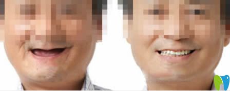 長春超龍牙博士口腔蔣唯全口種植牙案例