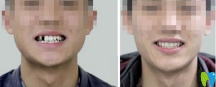 長春超龍牙博士單顆牙缺失種植案例