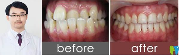 臺(tái)州維多利亞青少年地包天矯正前后對(duì)比照