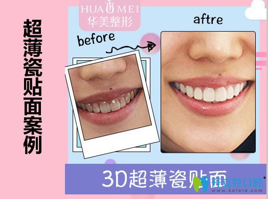 汕頭華美口腔<!--<i data=20240703-sp></i>-->超薄瓷貼面修復(fù)前后對(duì)比效果
