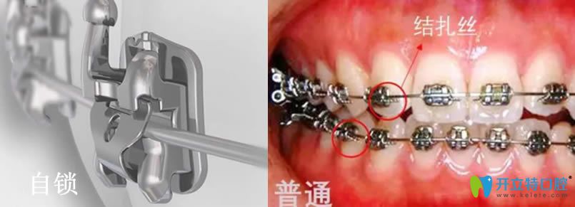 自鎖托槽矯正一萬貴嗎？自鎖托槽比金屬托槽好在哪里？