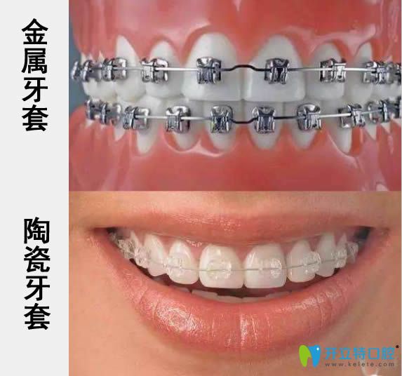 揭秘陶瓷和金屬牙套哪個好?通過價格及優(yōu)缺點來進行大比拼