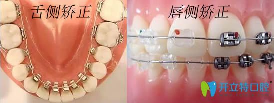 專業(yè)解答:唇側(cè)和舌側(cè)隱形矯正哪個好?并附上價格和效果圖