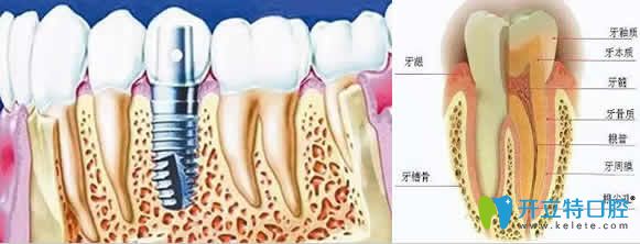 真牙和種植牙的咀嚼功能一樣嗎