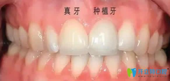 種植牙和真牙一樣嗎