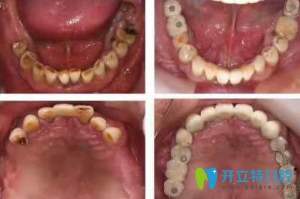<!--<i data=20240703-sp></i>-->恒愿齒科劉奎恒愿速生牙效果對比圖 <!--<i data=20240703-sp></i>-->恒愿齒科劉奎恒愿速生牙效果對比圖