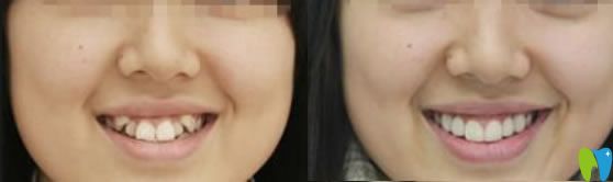 30歲虎牙矯正牙齒案例及前后對比照