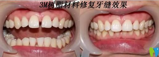 美國(guó)3M樹脂材料修復(fù)牙縫效果對(duì)比圖