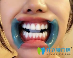 我在蘇州錦城口腔剛做完全瓷牙貼面的即刻照