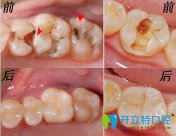 美國(guó)3M納米樹脂補(bǔ)牙效果對(duì)比圖