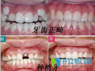 蘇州錦誠口腔牙齒正畸和種植牙效果圖