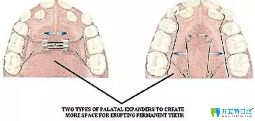 腭擴張器（上頜擴張器）