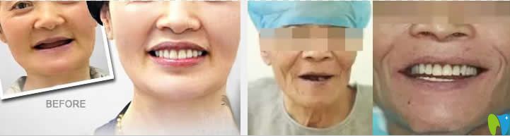 <!--<i data=20240703-sp></i>-->圣貝口腔王申全口種植牙真實(shí)病例