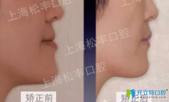 <!--<i data=20240703-sp></i>-->松豐口腔牙齒反頜矯正對(duì)比圖