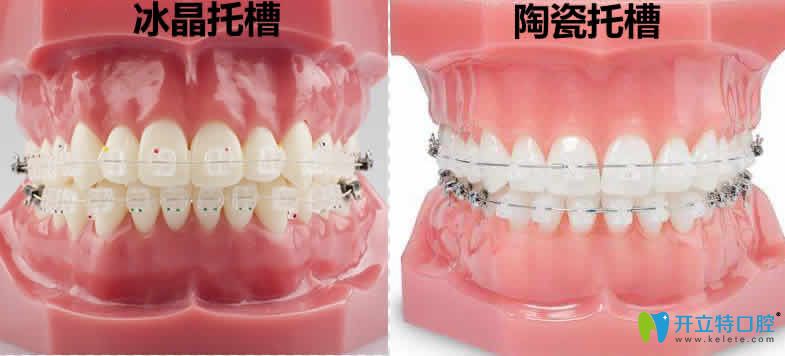 想知道冰晶托槽和陶瓷托槽哪個好?快來看兩個牙套的區(qū)別吧