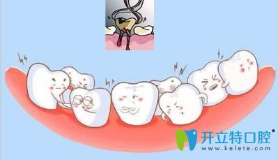 牙齒矯正時牙列擁擠就需要拔牙