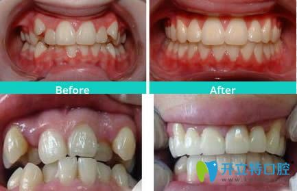 虎牙矯正前后對比圖片