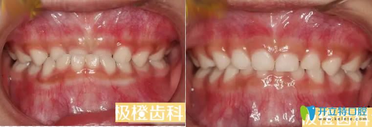 <!--<i data=20240703-sp></i>-->極橙齒科小孩地包天矯正案例及前后對(duì)比效果