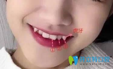 談虎牙矯正好還是拔除好?矯正虎牙(尖牙)價格是多少錢？