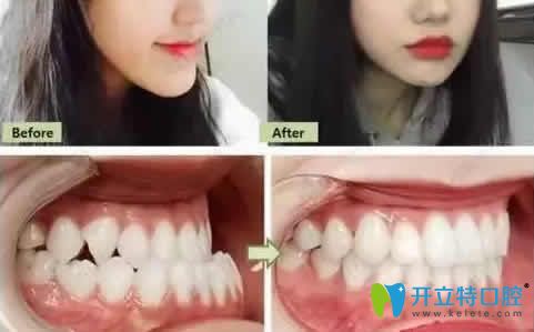 成人牙齒矯正為什么需要2年左右時(shí)間?正畸只要一年靠譜嗎?