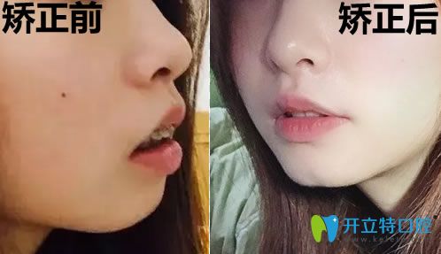 骨性齙牙拔了四顆牙臉型變化對(duì)比圖