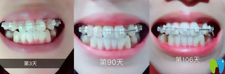 半隱形托槽矯正第3天-第106天變化圖